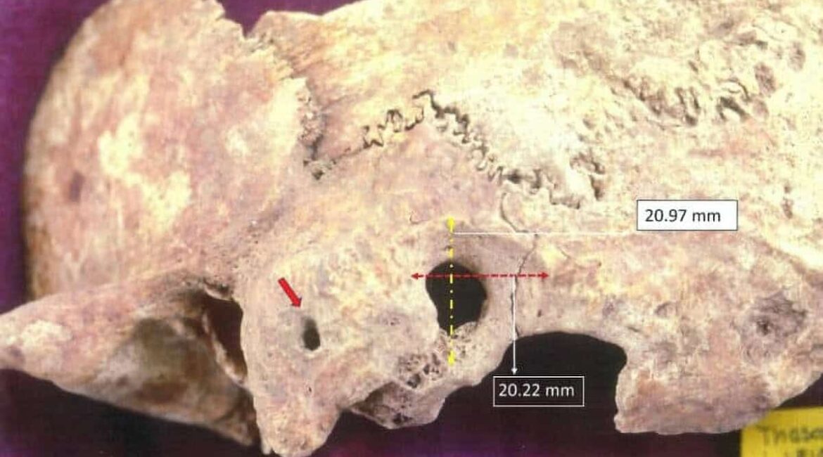 Adelphi Researcher Discovers Early, Complex Brain Surgery in Ancient Greece